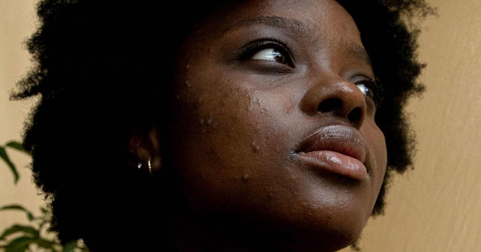 Tretinoin Has 38,100 TikTok Posts — And a Prescription Problem Person applying skincare product to face in natural light